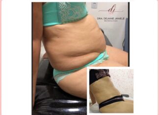 Quer usar biquíni sem inseguranças? A esteticista Dejaine pode te ajudar! Leia a matéria: