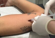 Sinop ultrapassa 1,6 mil aplicações gratuitas do contraceptivo Implanon