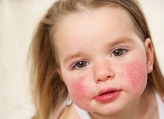 Anvisa aprova medicamentos pediátricos para lúpus e esclerose múltipla